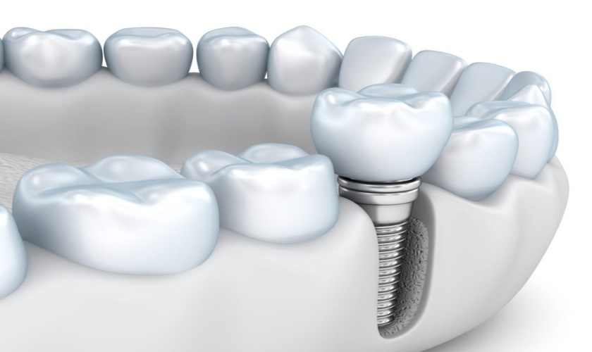 Cấy implant mất thời gian bao lâu? Giá cấy implant bao nhiêu cho một răng?